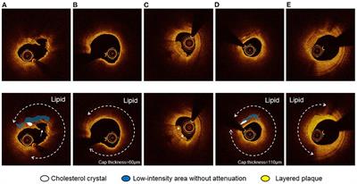 Predictors of Near-Infrared Spectroscopy-Detected Lipid-Rich Plaques by Optical Coherence Tomography-Defined Morphological Features in Patients With Acute Coronary Syndrome